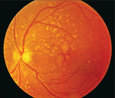 age-related-macular-degeneration