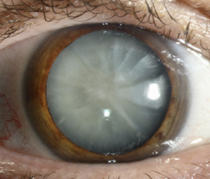 cataract