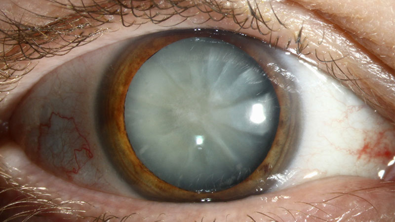 cataracts