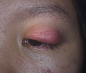 cellulitis