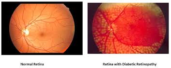 diabetic-retinopathy