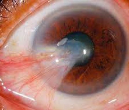 pterygium