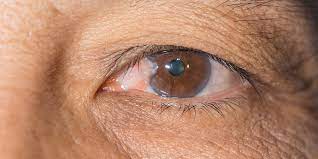 pterygium